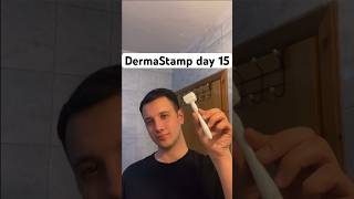 Dermastamp day 15Dermaroller nedir Dermaroller nasıl kullanılır dermaroller hair saç haircare [upl. by Tterag]