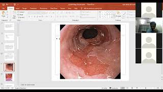 Gastrointestinal Pathology Clinical Representation  Esophagus Cancer  Stomach Disorders [upl. by Niels]