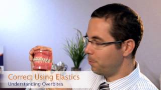 The Common Causes and Solutions to Overbites  Beecroft Orthodontics [upl. by Aletse]