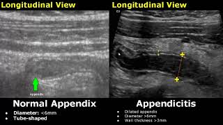 Appendix Ultrasound Normal Vs Abnormal Image Appearances  Appendicitis USG Scan [upl. by Ellenyl]