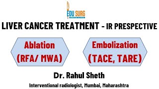 Ablation chemoembolization and radioembolization in primary liver cancer  hepatocellular carcinoma [upl. by Bone]