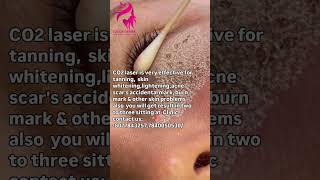 CO2 laser is very effective for tanning skin whiteningacne scars Clinicus80778432577840050530 [upl. by Natalie]