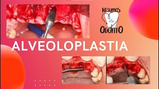 Alveoloplastia  Resumos de Odonto [upl. by Arot]