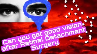 14 Can you get good VISION after Retinal Detachment Surgery RETINAL DETACHMENTretinaldetachment [upl. by Ahsiekrats]