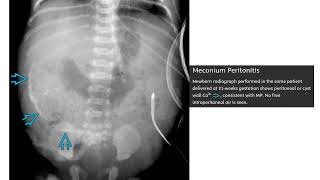 Meconium Peritonitis Imaging [upl. by Alaunnoif]