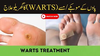 Warts Plantar warts Chandi treatment at home in UrduHindi [upl. by Tonl137]