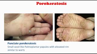 Porokeratosis [upl. by Soiritos590]