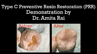 Type C Preventive Resin Restoration PRRDemonstration by Dr Amita Rai [upl. by Ardied821]