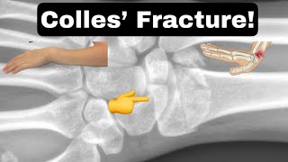 Colles’ Fracture facts shorts collesfracture [upl. by Hniv]