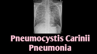 Pneumocystis Carinii Pneumonia  PCP  Pneumocystis Jirovecii [upl. by Jala491]