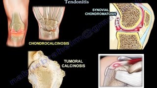 Chondrocalcinosis Tumoral Calcinosis synovial chondromatosis and calcific tendonitis [upl. by Annav]