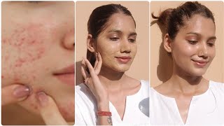 कितने भी मुस्किल pimple amp acne को बोलो अलविदा  clear tiny bump on face [upl. by Oinesra]