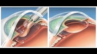 Cataract Surgery Animation [upl. by Gilbye]