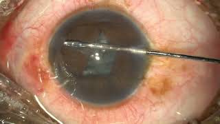 BHEX ring use during retinal surgery [upl. by Oratnek]