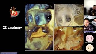 Pulmonary Vein assessment [upl. by Adlare]