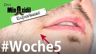 Fortschritte und Nebenwirkungen  Das Minoxidil Experiment Woche5 [upl. by Monjo548]