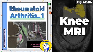 Fig 5E04 Rheumatoid Arthritis  Erosion and Synovitis [upl. by Festatus]