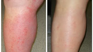 4 Natural Cures for Eczema  How to Cure Eczema Fast [upl. by Rieth]