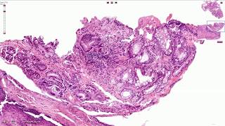 Barrett Esophagus  Histopathology [upl. by Syned]