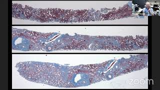 Dr Helmut Rennke  The Pathology of Thrombotic Angiopathies [upl. by Okiram]