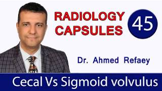 Radiology capsule  cecal vs sigmoid volvulus  Dr Ahmed Refaey [upl. by Neladgam753]