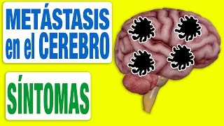 Todos los Síntomas de las Metástasis en el Cerebro [upl. by Adniralc]