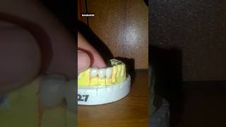 Ceramics And Metal capshortvideo dental teeth new [upl. by Asfah]