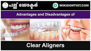 Advantages and Disadvantages of Clear Aligners  kannada Video  DrSreelakshmi [upl. by Ahab134]