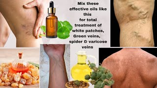 MIX THESE OILS TO CLEAR WHITE PATCHES amp GREEN VIENS  SKIN REPAIR OIL  RESULT IN 7 14 DAYS [upl. by Nhguahs]