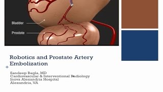 Advantages of Prostate Artery Embolization with the Magellan Robotic System [upl. by Saul]