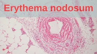 What is Erythema Nodosum  Pathology mini tutorial [upl. by Rondi468]