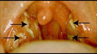 Angine Inflammation des amygdales amygdalite [upl. by Sabina]