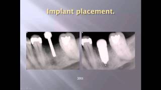 Implant 19 custom abutment and Emax crown [upl. by Wertheimer]