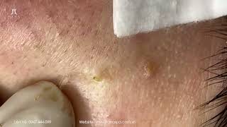 Big Cystic Acne Blackheads Extraction Blackheads amp Milia Whiteheads Removal Pimple Popping [upl. by Hgielah]