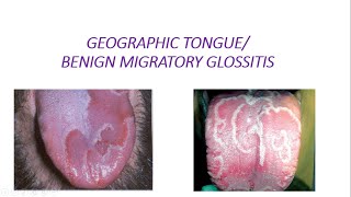 GEOGRAPHIC TONGUE [upl. by Jacky776]