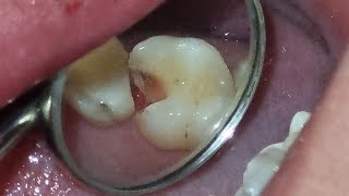 Endodontia Microscópica  dente 16  canal e restauração [upl. by Mighell]