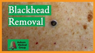 Blackhead Removal without Extractor Tool Edited  Auburn Medical Group [upl. by Essirehs961]