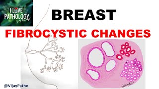 Diseases of Breast Part 1 Normal anatomy Classification amp FIBROCYSTIC CHANGES [upl. by Terrill]