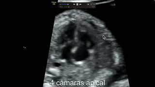 Ecocardiografia fetal Doppler color e insuficiencia tricuspidea Manipulación correcta del PRF [upl. by Aivatnahs354]