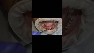 Lower arch full basal dental implants 8 welded post 5 months healing check shorts [upl. by Nuahsyar]