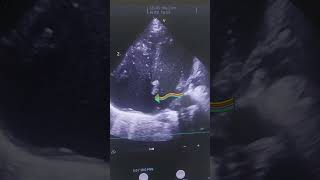 Echo Imaging for Detecting PFO in Preterm Neonates neonates echo neonatology [upl. by Ailicec]