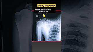 Clavicle Fracture ⚡ XRay shoulder xray shorts [upl. by Ettolrahs]