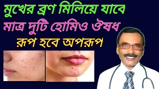 মুখের ব্রণ সারানোর হোমিও ঔষধ  acne pimple bron treatment  Dr SP Goswami [upl. by Ladnyk]