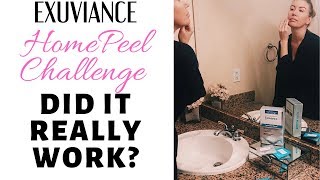 Do At Home Peels REALLY Work My Exuviance Peel Results [upl. by Constance743]