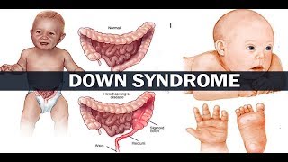 Down Syndrome  Symptoms CausesTypes Life expectancy  Best Hospitals [upl. by Tranquada]