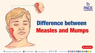 Measles and Mumps  Difference between Measles and Mumps  mumps measles [upl. by Atilahs]