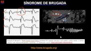 CURSO DE ELECTROCARDIOGRAFIA 60  SÍNDROME DE BRUGADA [upl. by Ahsinawt938]