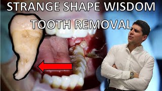 LOWER PARTIALLY ERUPTED WISDOM TOOTH REMOVAL Full procedure of extraction and explanation [upl. by Eelyram]