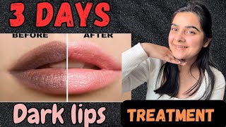 3 Days Dark Lips Removal Challenge  Get Rid Of Pigmented lips in Just 3 days [upl. by Ecnadnac171]