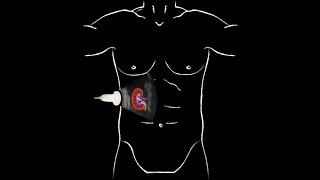 POCUS  Basic Renal Ultrasound [upl. by Lebasiram526]